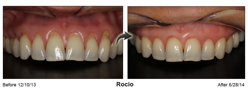 Before and Afte picture